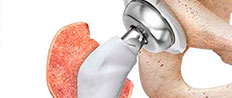 Medifarma IMPLANTES